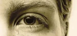 Alcoholic Jaundice Eyes